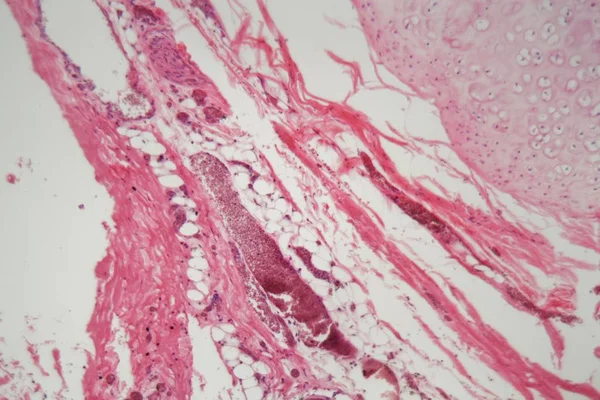 Lidská plicní tkáň s plicní embolií pod mikroskopem. — Stock fotografie