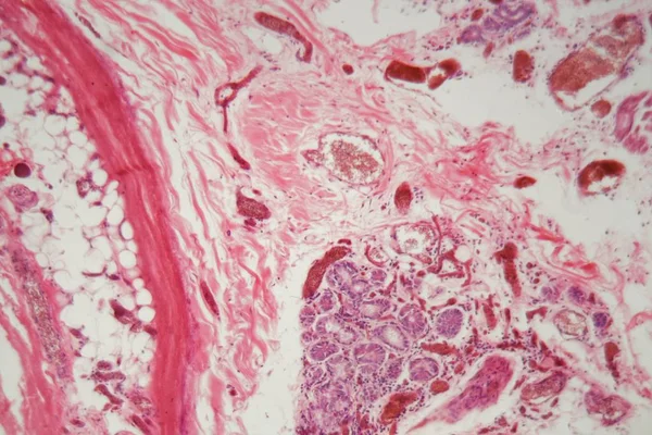 Ludzka tkanka płucna z zatorem płucnym pod mikroskopem. — Zdjęcie stockowe