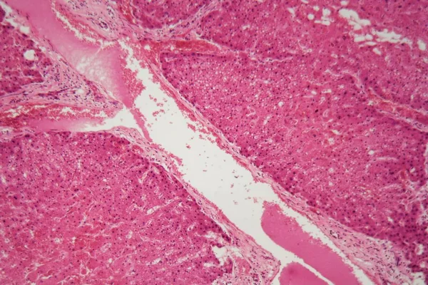 Leverweefsel met amyloïdose onder een microscoop. — Stockfoto