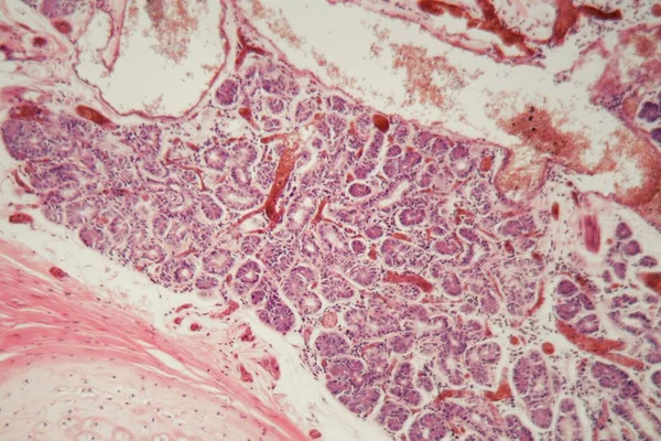 Tejido pulmonar humano con embolia pulmonar bajo un microscopio . — Foto de Stock