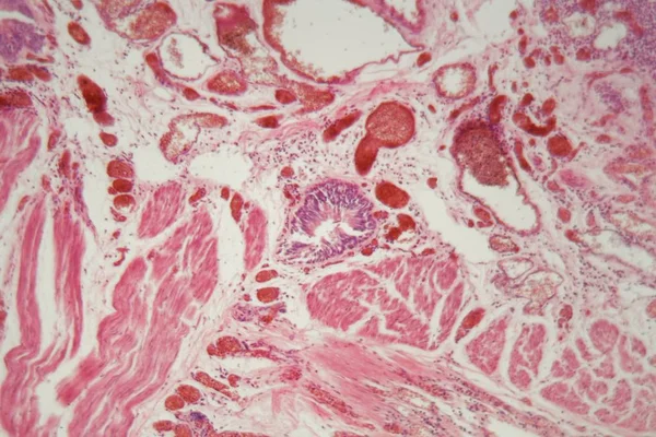 Tecido pulmonar humano com embolia pulmonar ao microscópio . — Fotografia de Stock
