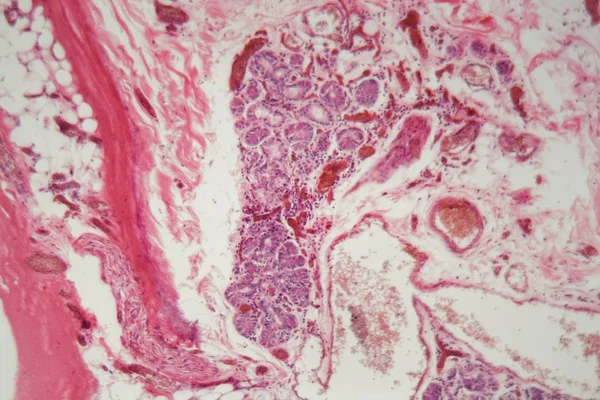 Tissu pulmonaire humain avec embolie pulmonaire au microscope . — Photo