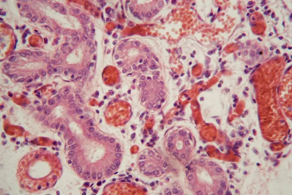 Ткани легких человека с легочной эмболией под микроскопом . — стоковое фото
