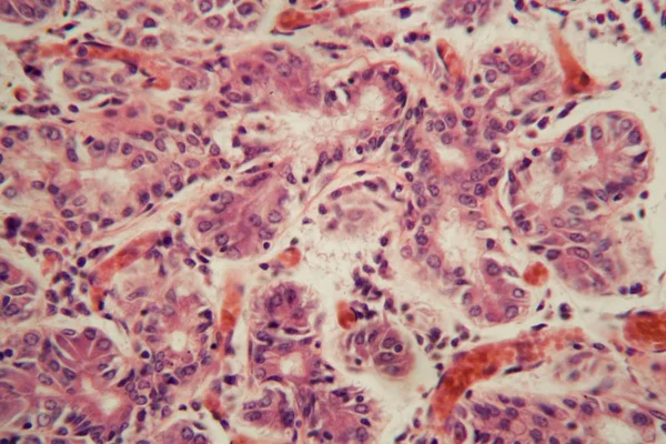 Emberi tüdőszövet mikroszkóp alatt tüdőembóliával. — Stock Fotó