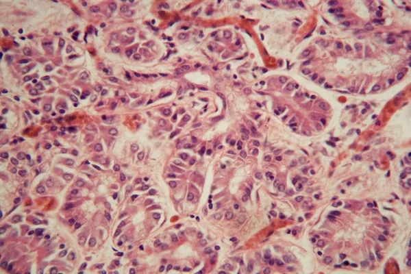 Human lung tissue with Pulmonary embolism under a microscope.