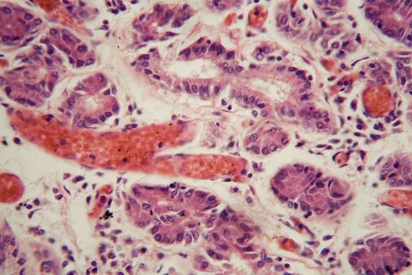 현미경 아래 폐색전증 이 있는 사람의 폐조직. — 스톡 사진