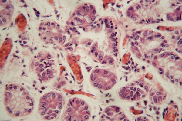 Human lung tissue with Pulmonary embolism under a microscope.