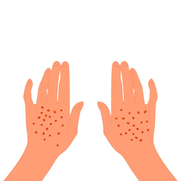 Erupción roja en la parte posterior de las manos femeninas. Enfermedad de la piel, alergia, inflamación. Aislado sobre fondo blanco. Estilo plano vector de stock . — Vector de stock