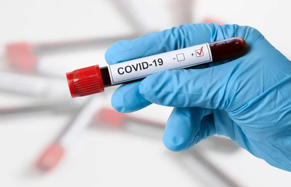 Prueba Coronavirus Resultado Positivo — Foto de Stock