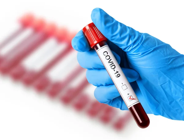 Test Coronavirus Positive Result — Stock Photo, Image