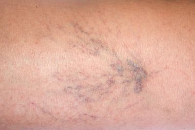 Varis kadın. Sağlık sorununuzu.