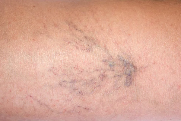 Varis kadın. Sağlık sorununuzu.