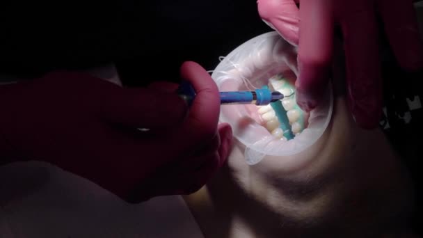 Diş hekimi doktor kadın hasta için diş beyazlatma yapıyor — Stok video