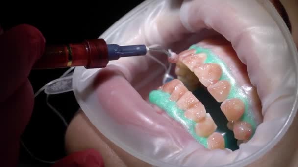 Dentist doctor doing teeth whitening for woman patient — Stock Video
