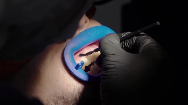 Стоматолог отбеливает зубы пациенту — стоковое видео