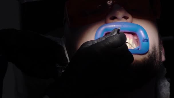 Відбілювання зубів для пацієнта — стокове відео