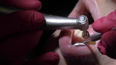 Diş hekimi diş hasta için temizlik yapma