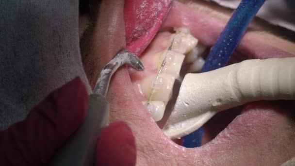 Стоматолог делает чистку зубов для пациента — стоковое видео