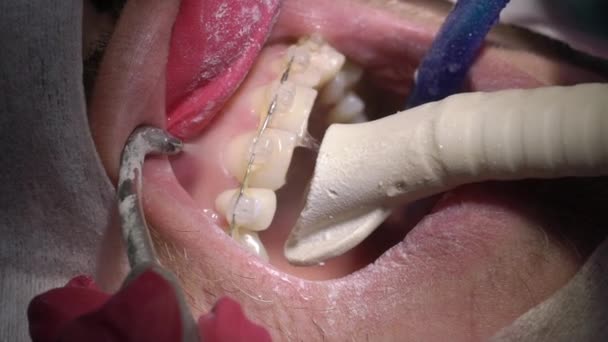 Zahnarzt macht Zahnreinigung für Patienten — Stockvideo