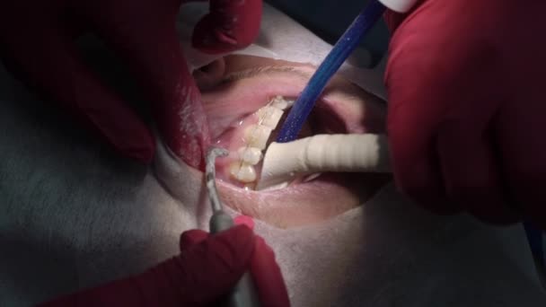 Dentista haciendo limpieza dental para el paciente — Vídeo de stock