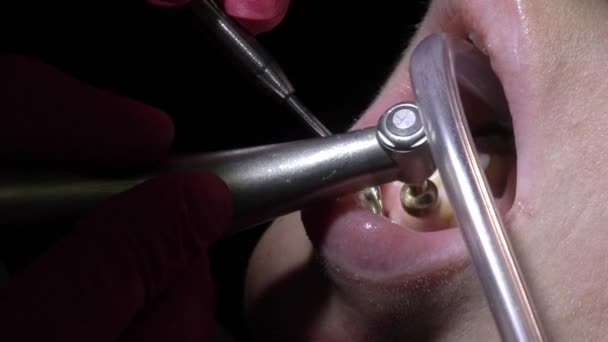 Dentista haciendo limpieza dental para el paciente — Vídeo de stock