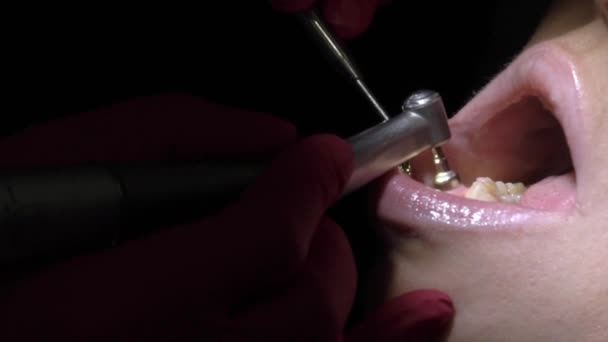 Diş hekimi diş hasta için temizlik yapma — Stok video