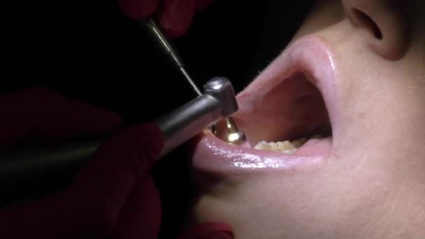 Zubař, takže zub čištění pro pacienta — Stock video