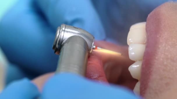Perceuse dentaire dans la bouche du patient — Video