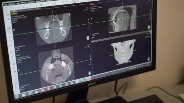 SAIT-PETERSBURG, RUSIA - 21 DE MARZO DE 2018: Resultados de la tomografía por rayos X — Vídeos de Stock