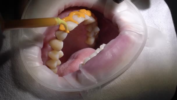 Dentista médico haciendo blanqueamiento de dientes para paciente mujer — Vídeo de stock