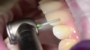 Diş matkap boer hasta ağzına