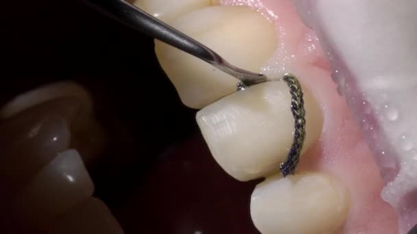 Médico dentista fazendo moldes dentários — Vídeo de Stock