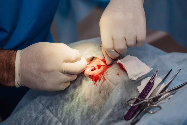 Surgeon putting on stitches during cosmetic plastic surgery — Stock Photo, Image