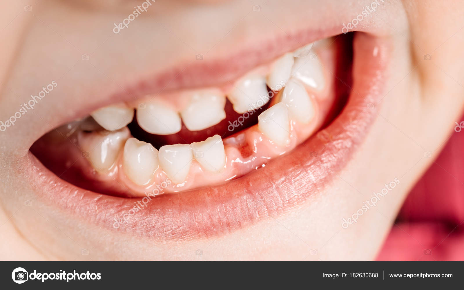 Milk Tooth Fell Out Stock Photo by ©kaninstudio 182630688