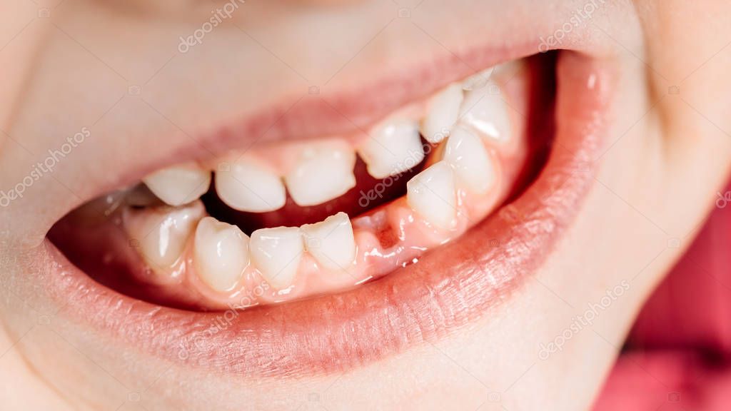 Milk Tooth Fell Out — Stock Photo © kaninstudio #182630688