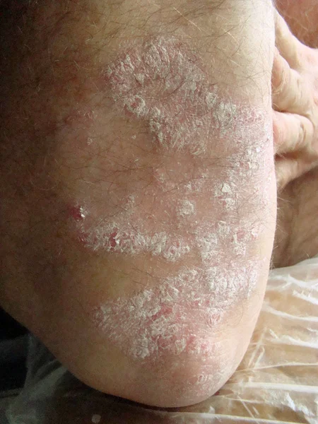 Psoriasis pada kulit — Stok Foto