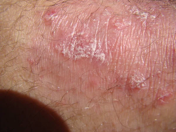 Psoriasis bangkit dari setan — Stok Foto