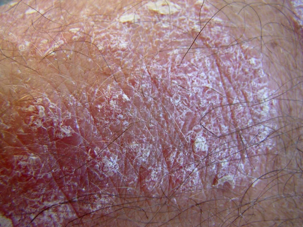 Psoriasis rosa del diablo — Foto de Stock