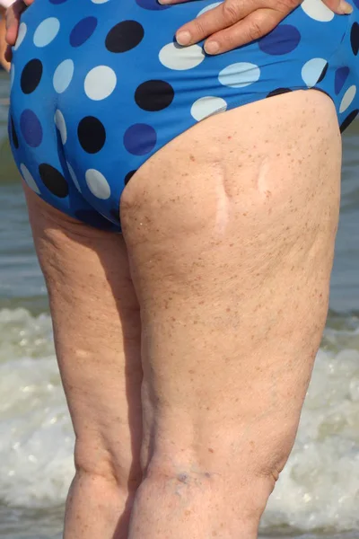 Obezite insan vücudunun