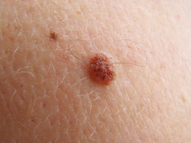 Nevus
