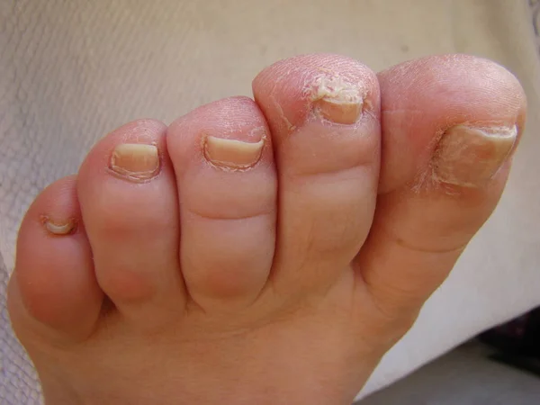 Nail Fungus Your Toes Kind Infected Nails Close — Stock Photo, Image