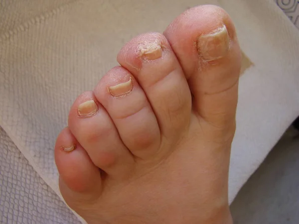 Nail Fungus Your Toes Kind Infected Nails Close — Stock Photo, Image