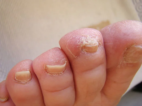 Nail Fungus Your Toes Kind Infected Nails Close — Stock Photo, Image