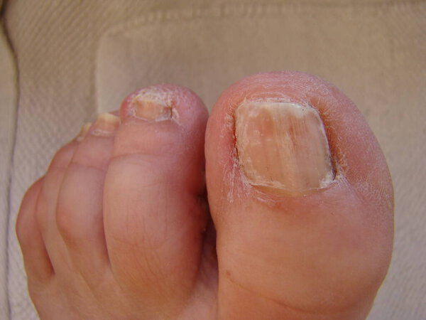 Nail fungus on your toes kind of infected nails close-up