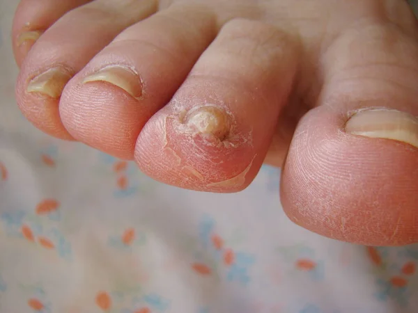 Грибок Ногтей Пальцах Ног Вроде Инфицированных Ногтей Крупным Планом — стоковое фото