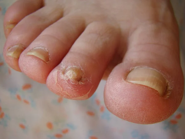 Грибок Ногтей Пальцах Ног Вроде Инфицированных Ногтей Крупным Планом — стоковое фото