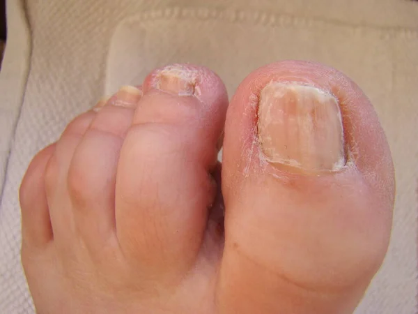 Nagelpilz Auf Den Zehen Art Von Infizierten Nägeln Nahaufnahme Stockbild