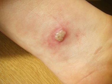 Bebeğin bacağındaki Herpis, yakın plan fotoğraf kızarıklığı olan bir hastalıktır.