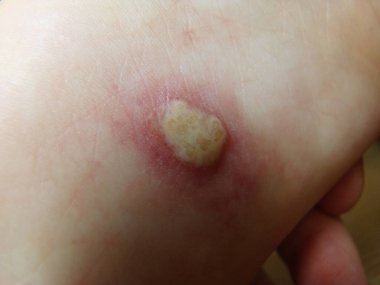 Bebeğin bacağındaki Herpis, yakın plan fotoğraf kızarıklığı olan bir hastalıktır.