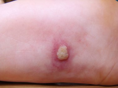 Bebeğin bacağındaki Herpis, yakın plan fotoğraf kızarıklığı olan bir hastalıktır.